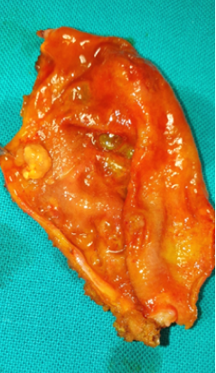 Χειρουργικά παρασκευάσματα. Πολύποδες χοληδόχου κύστης (Ευγενική παραχώρηση Dr. V. Penopoulos)