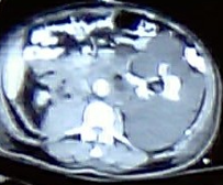 CT Scan. Caroli disease from another patient (Courtesy Dr. V. Penopoulos)