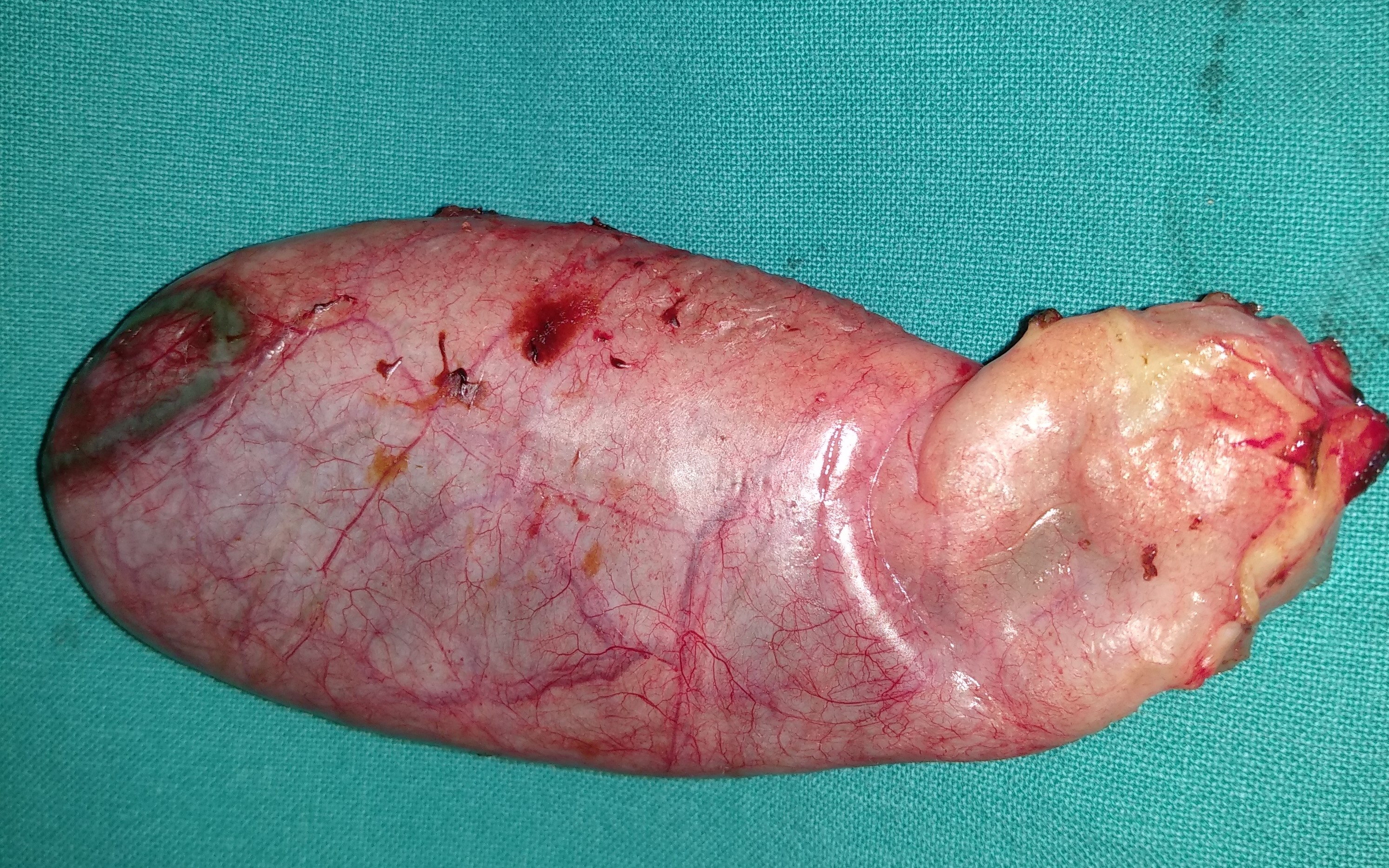 Cholangiography. Caroli disease from another patient (Courtesy Dr. V. Penopoulos)