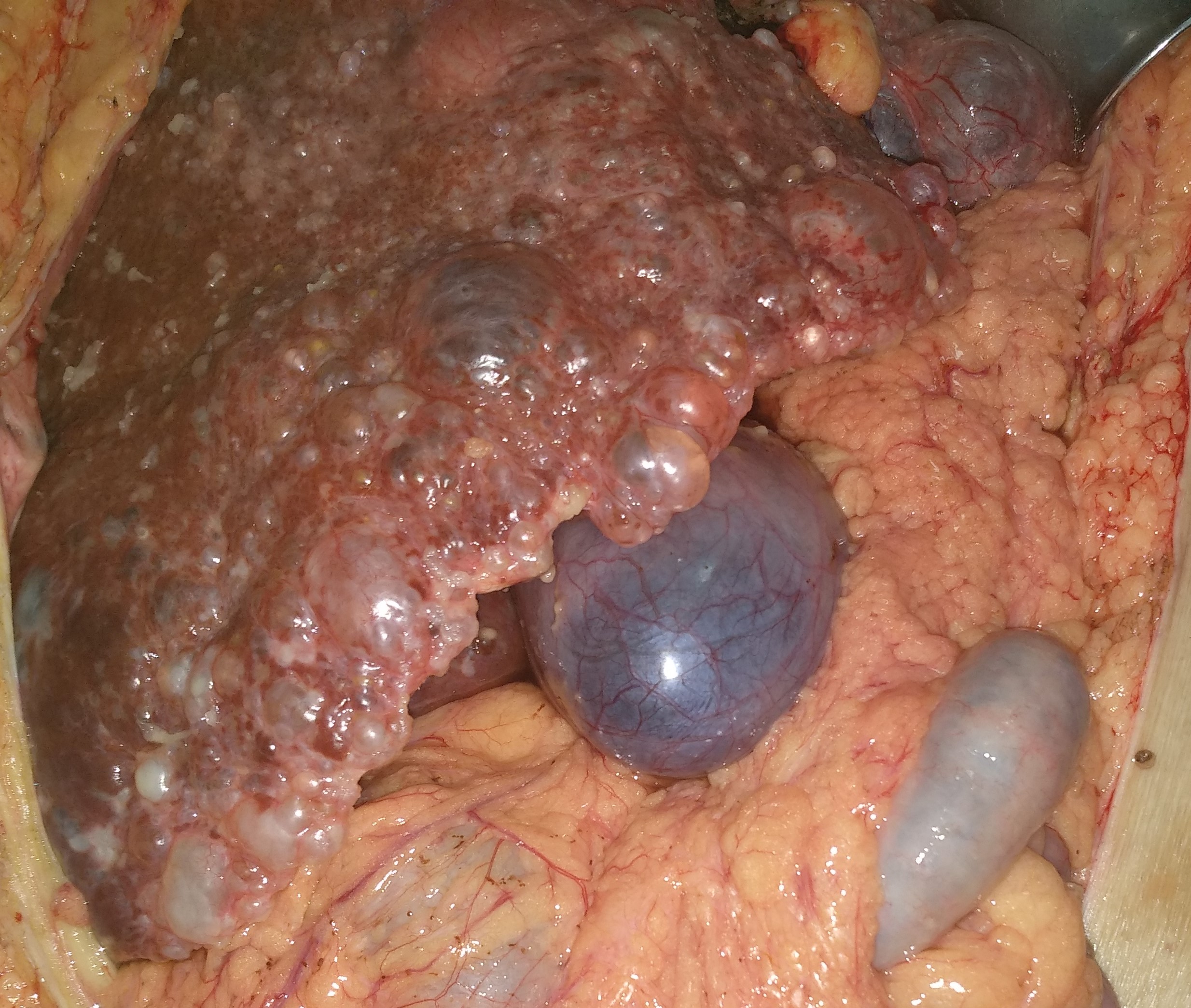 Cholangiography. Caroli disease from another patient (Courtesy Dr. V. Penopoulos)