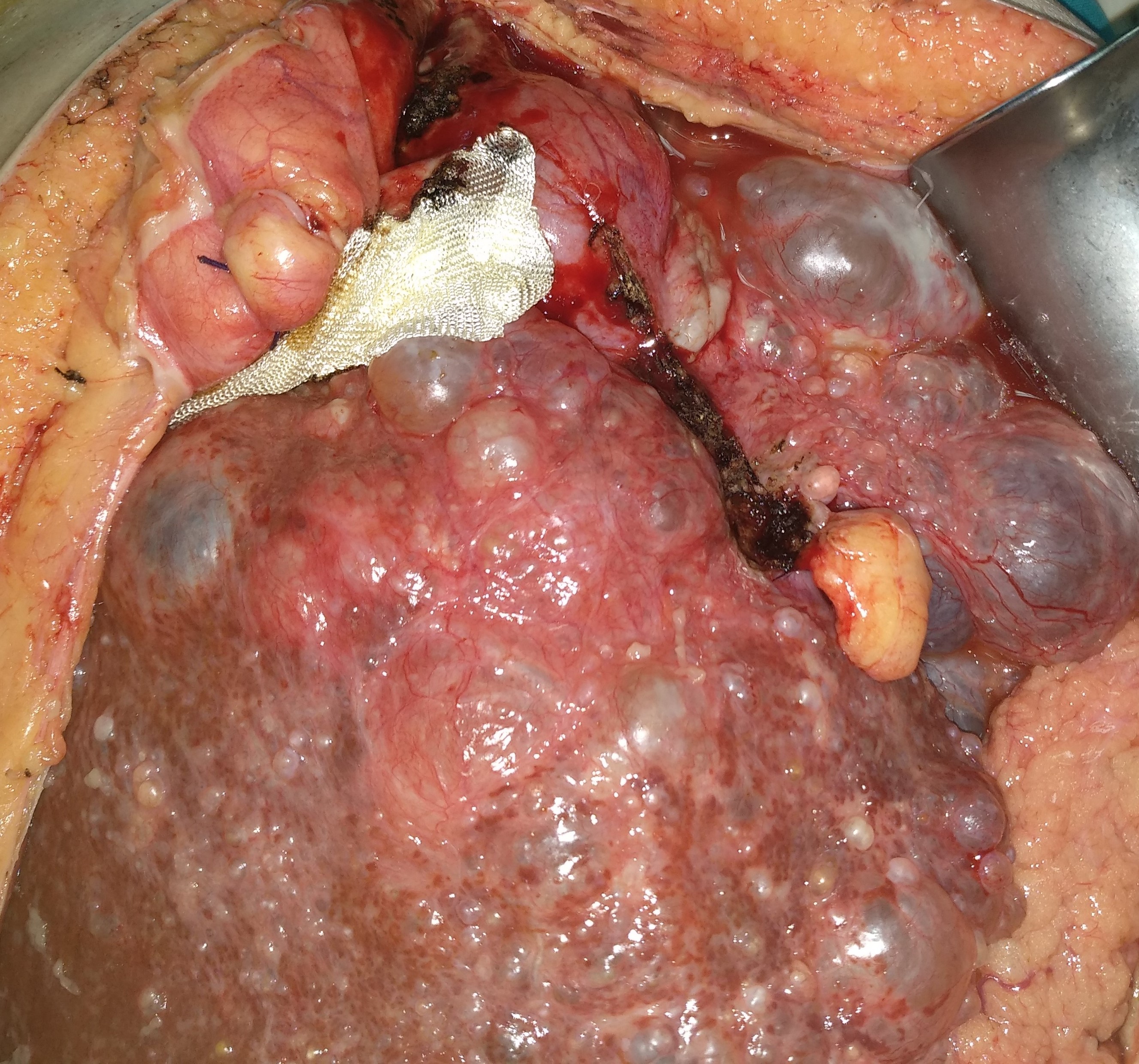Cholangiography. Caroli disease from another patient (Courtesy Dr. V. Penopoulos)