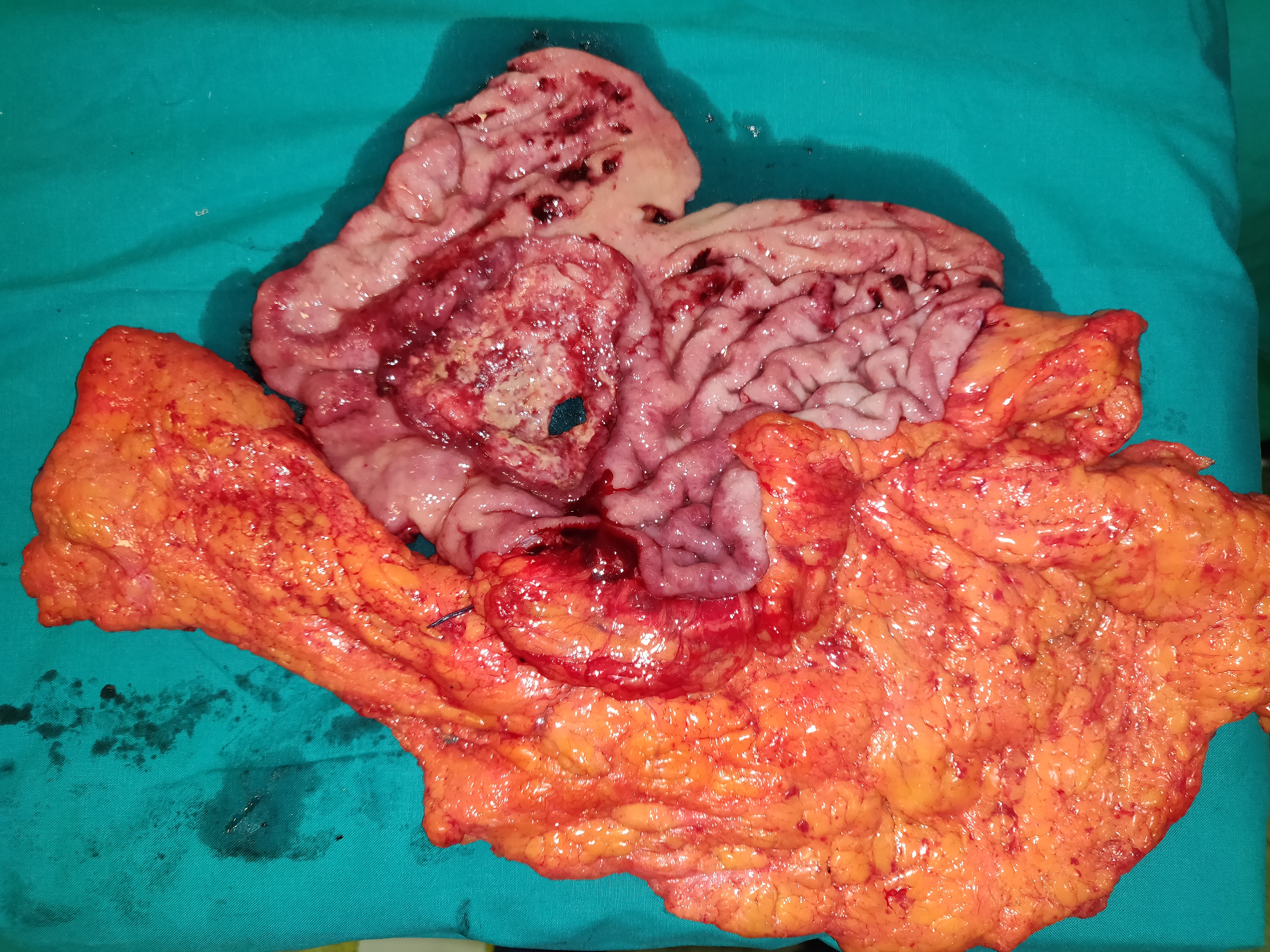 Cholangiography. Caroli disease from another patient (Courtesy Dr. V. Penopoulos)