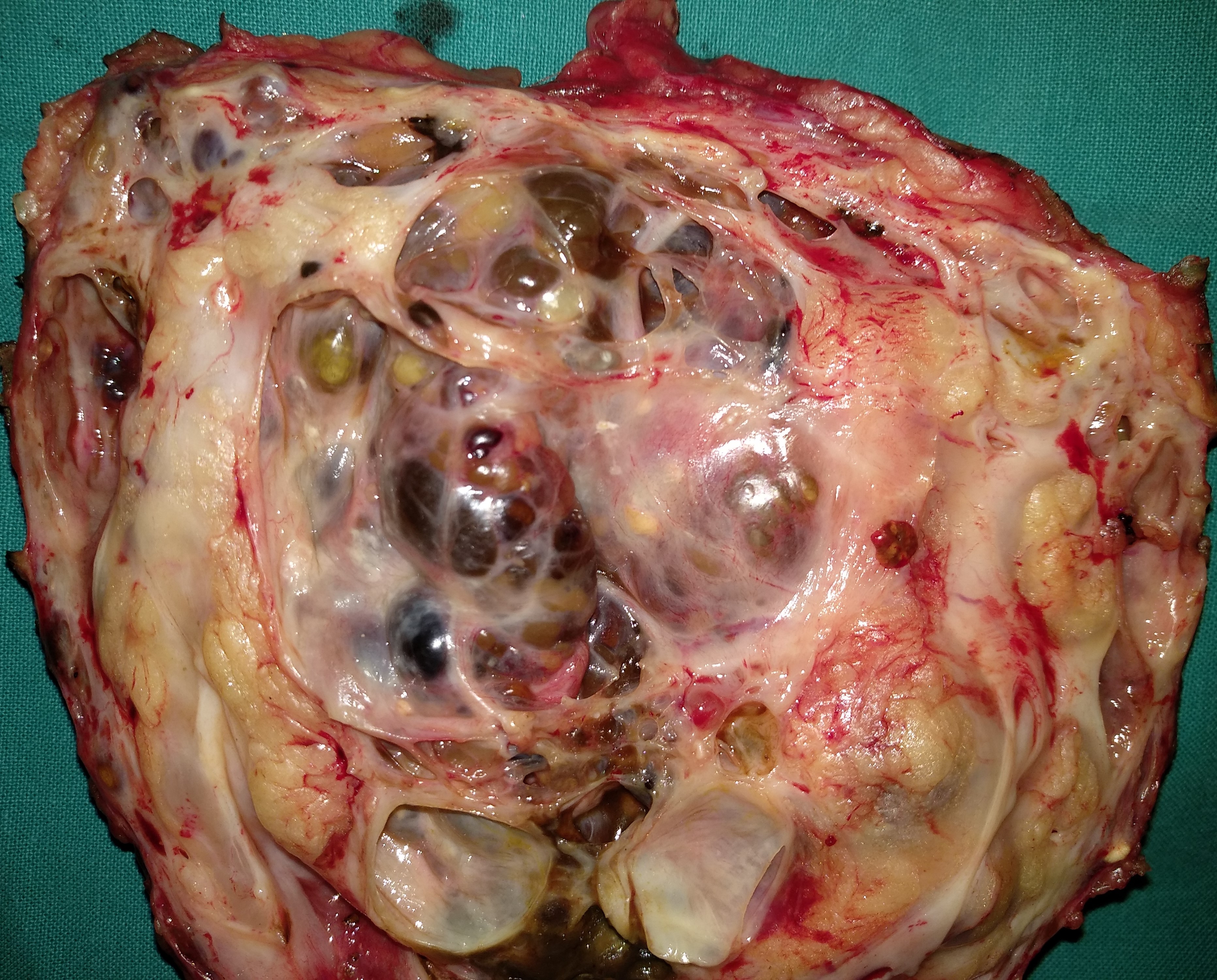 Cholangiography. Caroli disease from another patient (Courtesy Dr. V. Penopoulos)