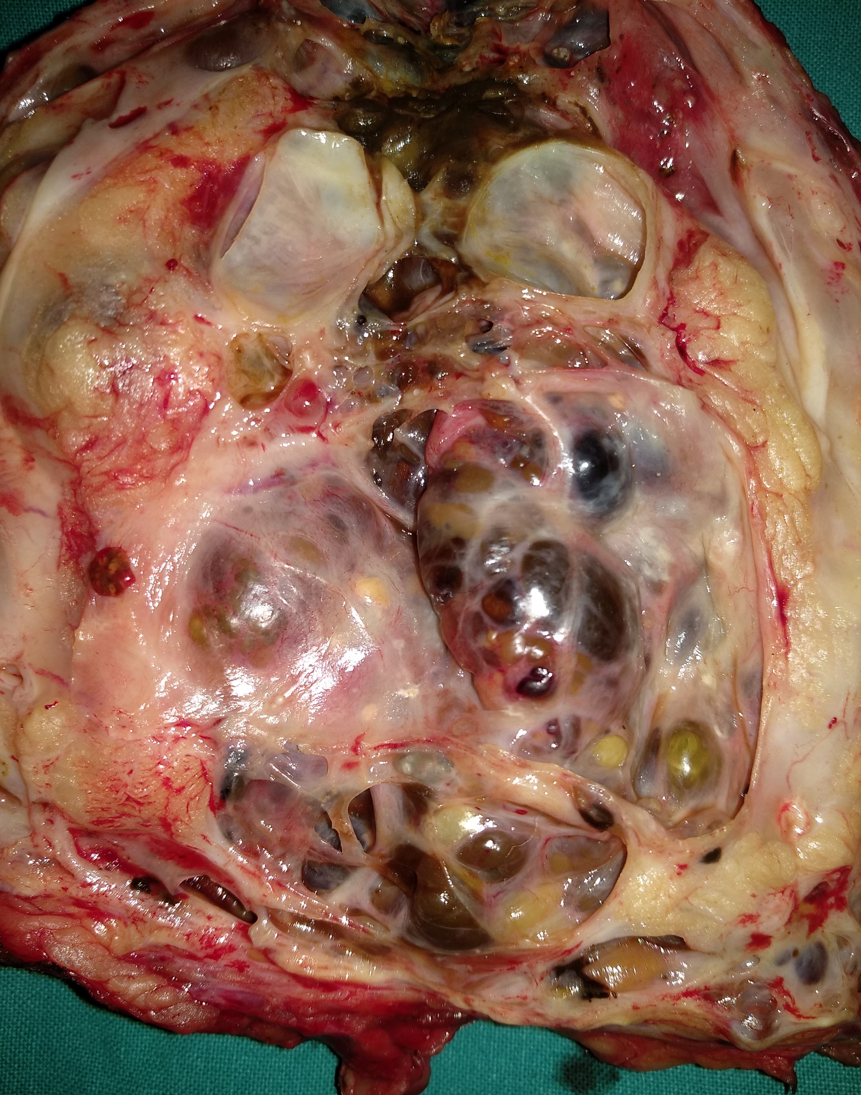 Cholangiography. Caroli disease from another patient (Courtesy Dr. V. Penopoulos)