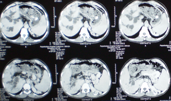 Cholangiography. Caroli disease from another patient (Courtesy Dr. V. Penopoulos)