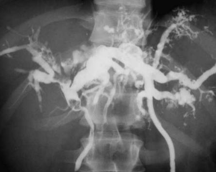Cholangiography. Caroli disease from another patient (Courtesy Dr. V. Penopoulos)