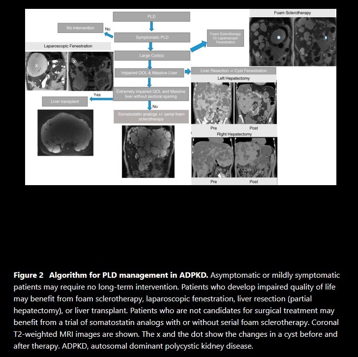 Polycystic liver disease. Red arrow. Infected hepatic cyst (Courtesy Dr. V. Penopoulos)
