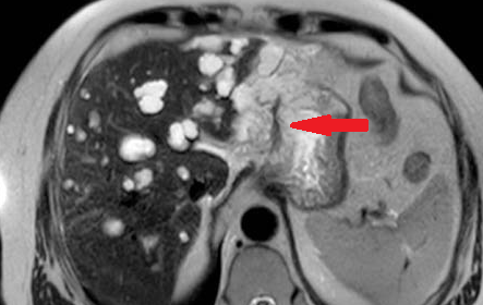 Polycystic disease of both kidneys (Courtesy Dr. V. Penopoulos)