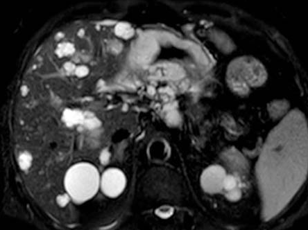 Polycystic disease of both kidneys. Left pyonephrosis (Courtesy Dr. V. Penopoulos)