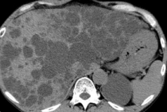 Cholecystectomy specimen (Courtesy Dr. V. Penopoulos)