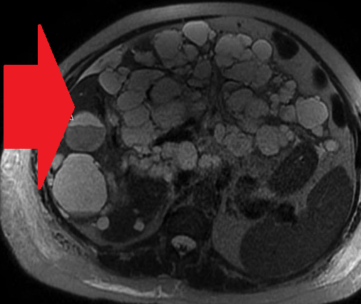 Liver after resection of the infected cyst. Presence of hemostatic Surgicel on the raw surface (Courtesy Dr. V. Penopoulos)