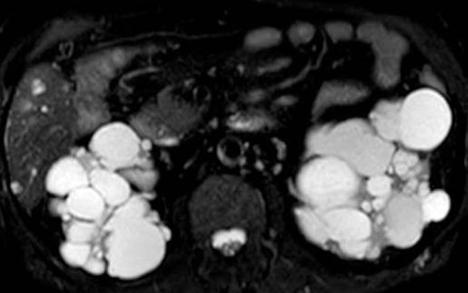 Total gastrectomy specimen (Courtesy Dr. V. Penopoulos)