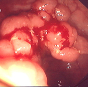 Κολονοσκόπηση. Κουνουπιδοειδής μάζα τυφλού (Ευγενική παραχώρηση Dr. V. Penopoulos)
