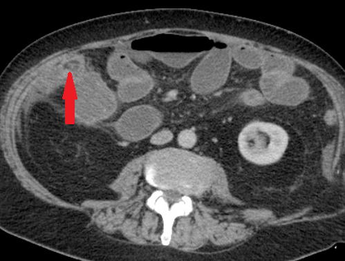 CT κοιλίας. Κόκκινο βέλος. Καρκίνωμα τυφλού (Ευγενική παραχώρηση Dr. V. Penopoulos)