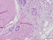 Διήθηση περικολικού λίπους (Ευγενική παραχώρηση Dr. V. Penopoulos)