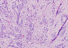 Περιφερειακή λεμφαδενική διήθηση (Ευγενική παραχώρηση Dr. V. Penopoulos)