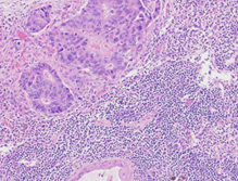 Περιφερειακή λεμφαδενική διήθηση (Ευγενική παραχώρηση Dr. V. Penopoulos)