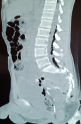 MRI οσφυοϊερής μοίρας. Αέρας είναι σαφώς ορατός εντός του σπονδυλικού σωλήνα (Ευγενική παραχώρηση Dr. V. Penopoulos)