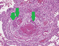 Ανοσοϊστοχημική εξέταση. Εμβολισμός από καρκινικά κύτταρα (Ευγενική παραχώρηση Dr. V. Penopoulos)