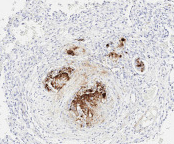 Καρκινωματώδης λεμφαγγειΐτιδα. Εύρημα νεκροτομής (Ευγενική παραχώρηση Dr. V. Penopoulos)