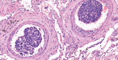 Καρκινωματώδης λεμφαγγειΐτιδα. Εύρημα νεκροτομής (Ευγενική παραχώρηση Dr. V. Penopoulos)