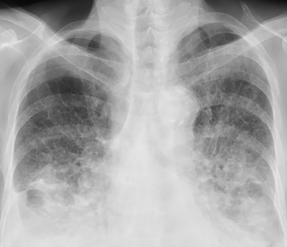 ΗΚΓ. Αναστροφή κυμάτων T στις απαγωγές V1-V4, ενδεικτική καταπόνησης δεξιάς κοιλίας (Ευγενική παραχώρηση Dr. V. Penopoulos)