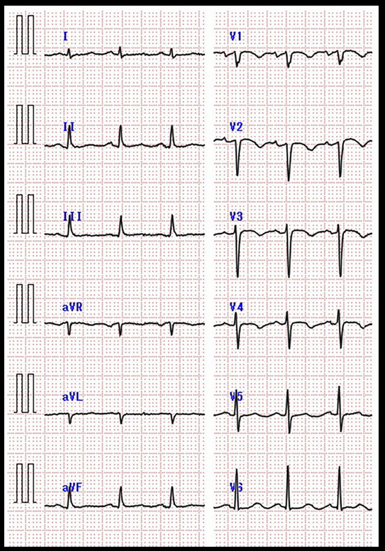 Καρδιακό υπερηχογράφημα. Διάταση δεξιάς κοιλίας, εύρημα ενδεικτικό πνευμονικής υπέρτασης (Ευγενική παραχώρηση Dr. V. Penopoulos)
