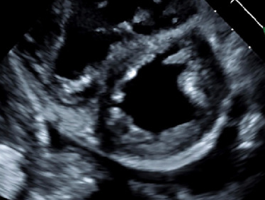 CT θώρακα. Θολερές αναλαμπές τύπου «θαμπού υάλου» (Ευγενική παραχώρηση Dr. V. Penopoulos)