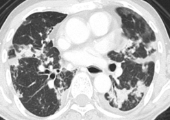 CT αγγειογραφία θώρακα. Κόκκινο βέλος - Έντονη διάταση της πνευμονικής αρτηρίας. Χωρίς ευρήματα πνευμονικής εμβολής (Ευγενική παραχώρηση Dr. V. Penopoulos)