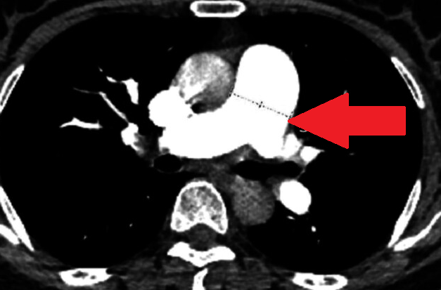 Κακώς διαφοροποιημένο καρκίνωμα στομάχου. Ιστοπαθολογική εξέταση (Ευγενική παραχώρηση Dr. V. Penopoulos)