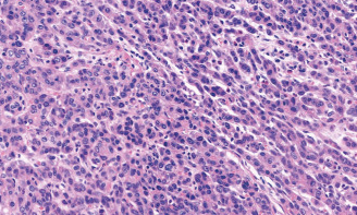 Επίχρισμα περιφερικού αίματος. Κόκκινο βέλοςs - Schistocytes. Πράσινο βέλος - Erythroblast (Ευγενική παραχώρηση Dr. V. Penopoulos)