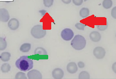 Κυψελιδική αιμορραγία (Ευγενική παραχώρηση Dr. V. Penopoulos)
