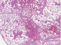 Ινοβλαστική πολλαπλασίαση αγγειακού έσω χιτώνα, θρόμβωση, εμβολισμός από καρκινικά κύτταρα (Ευγενική παραχώρηση Dr. V. Penopoulos)