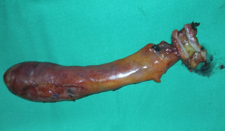 CT κοιλίας. Μεταστατικές εστίες στους σκελετικούς μύες δεξιά (κόκκινα βέλη) (Ευγενική παραχώρηση Dr. V. Penopoulos)