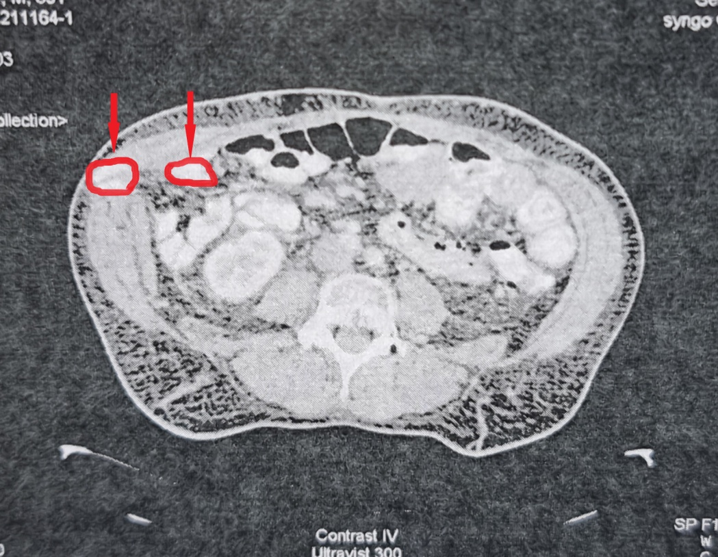Ψηλαφητές μεταστάσεις στον δεξιό λαγόνιο βόθρο (Ευγενική παραχώρηση Dr. V. Penopoulos)
