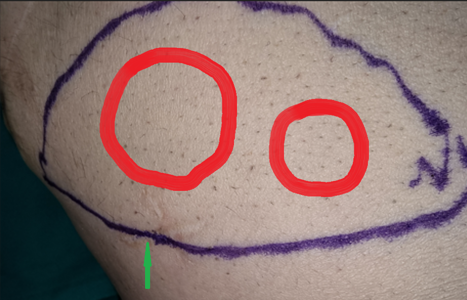 Ψηλαφητές μεταστάσεις στον δεξιό λαγόνιο βόθρο (Ευγενική παραχώρηση Dr. V. Penopoulos)