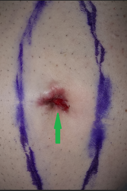 Ομφαλική μετάσταση (Όζος αδελφής Μαρίας Ιωσήφ) (Ευγενική παραχώρηση Dr. V. Penopoulos)