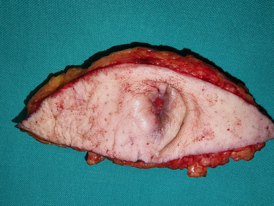 Ομφαλεκτομή (Ευγενική παραχώρηση Dr. V. Penopoulos)