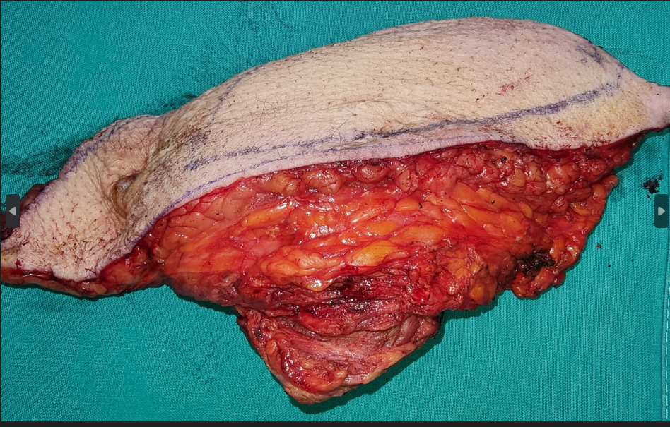 Περινευρική διήθηση χολαγγειοκαρκινώματος (Ευγενική παραχώρηση Dr. V. Penopoulos)
