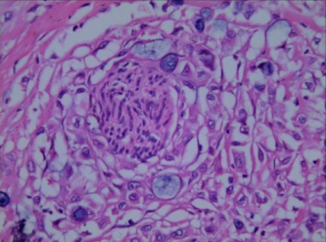 Περινευρική διήθηση χολαγγειοκαρκινώματος (Ευγενική παραχώρηση Dr. V. Penopoulos)