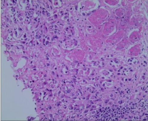 Περινευρική διήθηση χολαγγειοκαρκινώματος (Ευγενική παραχώρηση Dr. V. Penopoulos)