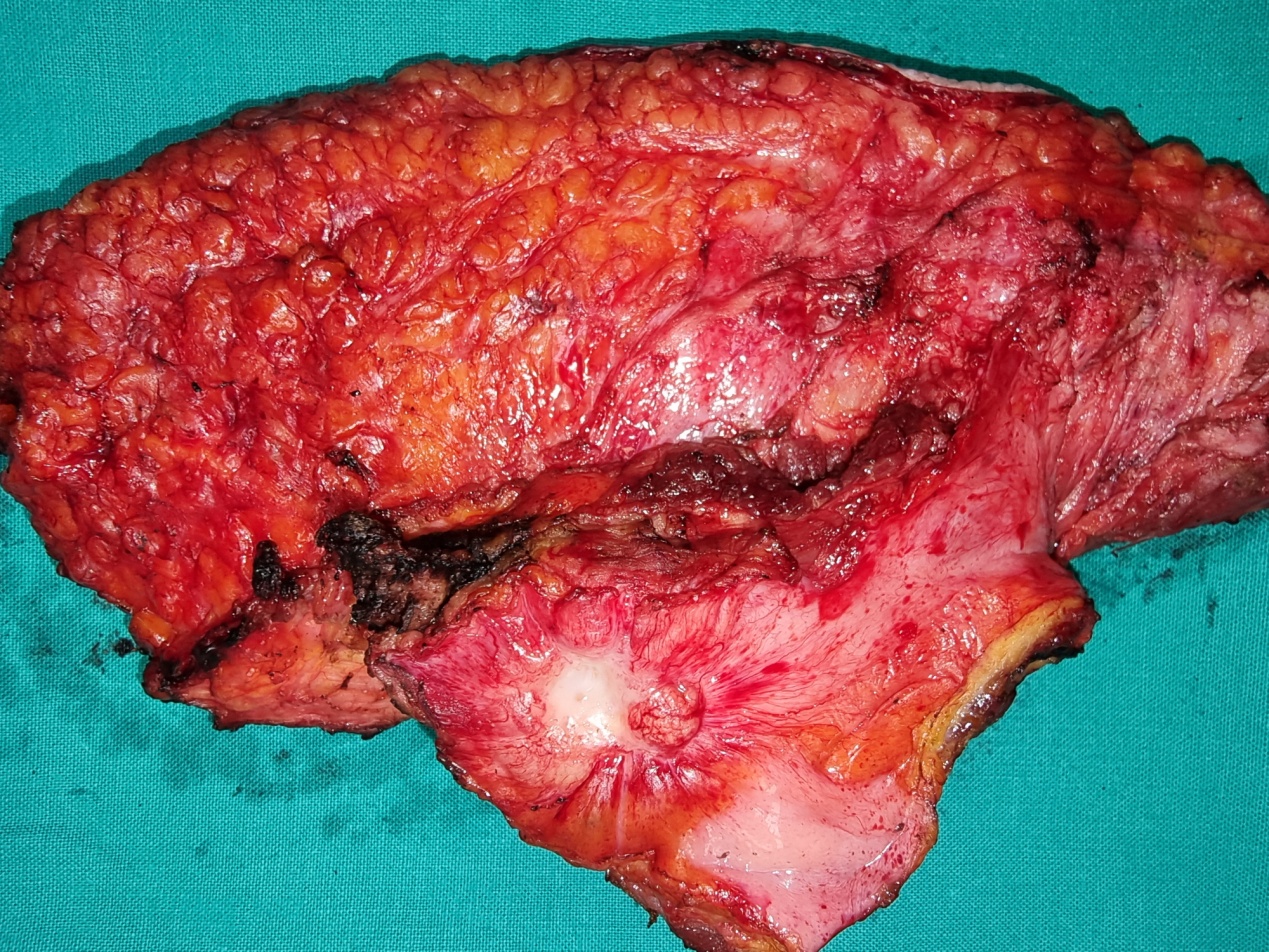 Μετάσταση χολαγγειοκαρκινώματος σε σκελετικούς μύες (Ευγενική παραχώρηση Dr. V. Penopoulos)