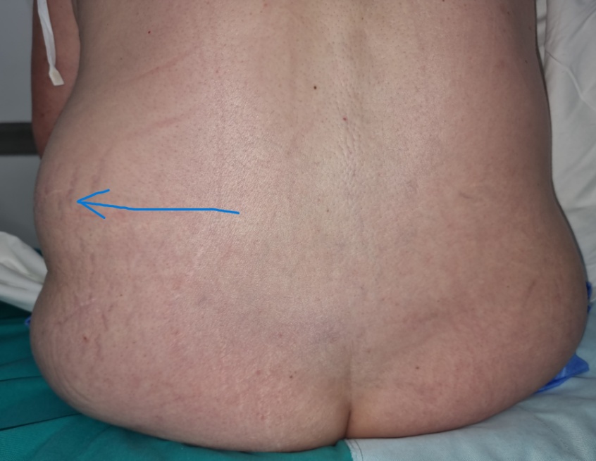 CT κοιλίας. Πρόπτωση παχέος εντέρου διά του κατώτερου οσφυϊκού τριγώνου (Ευγενική παραχώρηση Dr. V. Penopoulos)