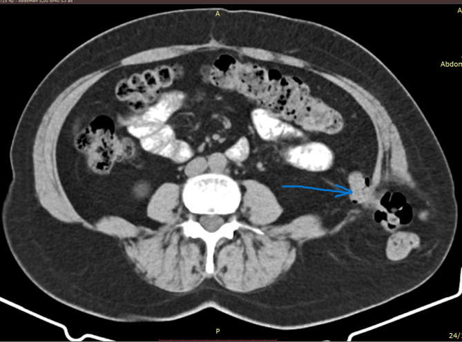 Προπίπτουσα οσφυϊκή κήλη. Τρίγωνο Petit (Ευγενική παραχώρηση Dr. V. Penopoulos)