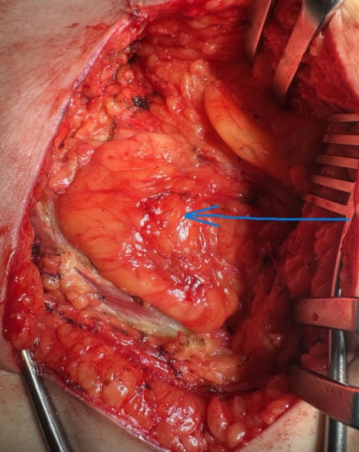 Προπίπτουσα οσφυϊκή κήλη. Τρίγωνο Petit (Ευγενική παραχώρηση Dr. V. Penopoulos)