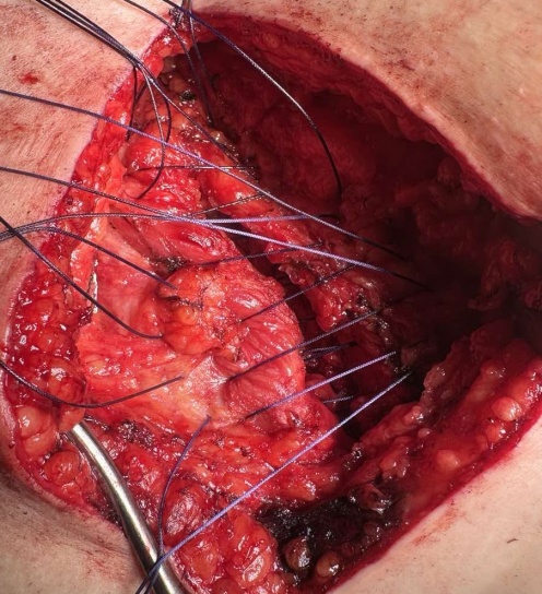 Κλείσιμο του ελλείμματος με διακεκομμένες ράμματα Vicryl No. 2 χωρίς τάση (Ευγενική παραχώρηση Dr. V. Penopoulos)