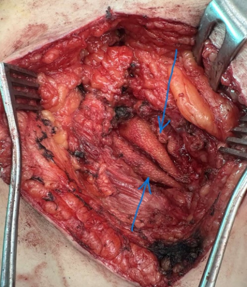 Πλήρης επιδιόρθωση της κήλης (Ευγενική παραχώρηση Dr. V. Penopoulos)