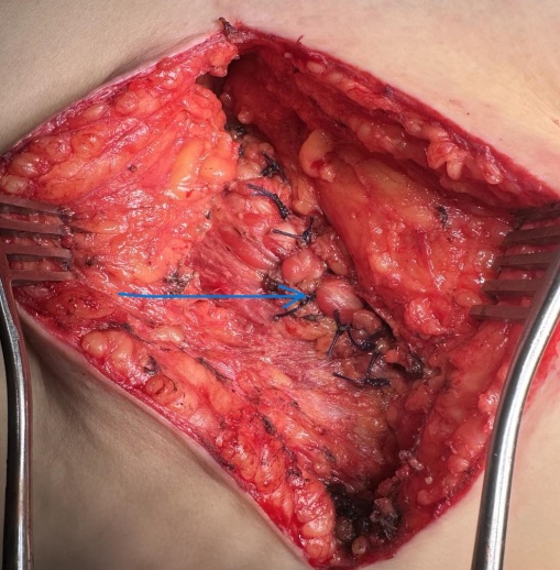 CT κοιλίας 1 (ένα) έτος μετά από χειρουργική επιδιόρθωση της οσφυϊκής κήλης. Πλήρης εξάλειψη του ελλείμματος (Ευγενική παραχώρηση Dr. V. Penopoulos)