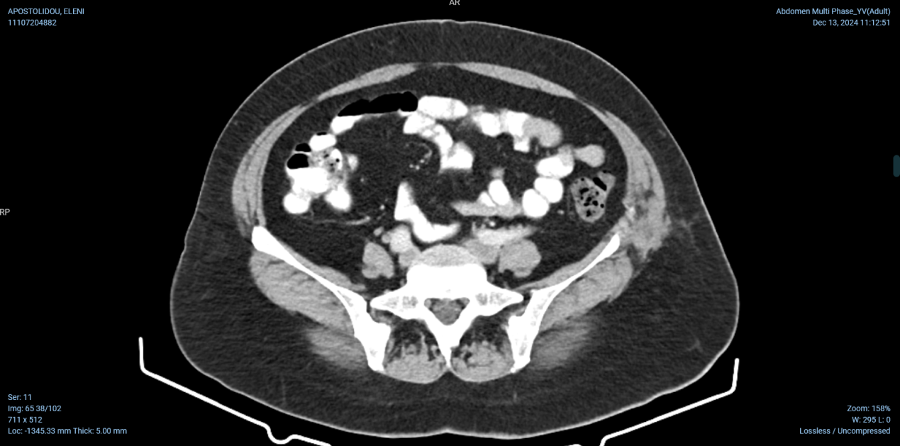 CT κοιλίας 1 (ένα) έτος μετά από χειρουργική επιδιόρθωση της οσφυϊκής κήλης. Πλήρης εξάλειψη του ελλείμματος (Ευγενική παραχώρηση Dr. V. Penopoulos)