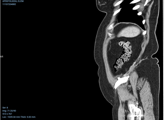 CT κοιλίας 1 (ένα) έτος μετά από χειρουργική επιδιόρθωση της οσφυϊκής κήλης. Πλήρης εξάλειψη του ελλείμματος (Ευγενική παραχώρηση Dr. V. Penopoulos)